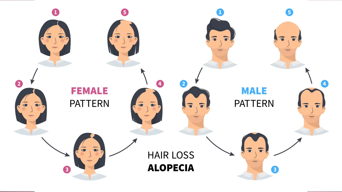 male and female pattern baldness stages diagramme